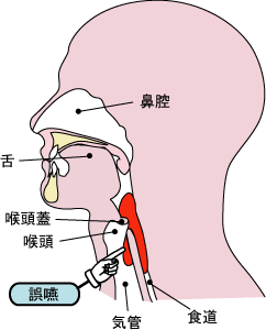 えん 性 肺炎 ご